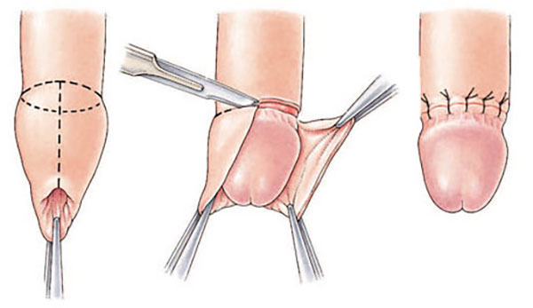 Hẹp da quy đầu ở trẻ nhỏ - Những điều cần biết 