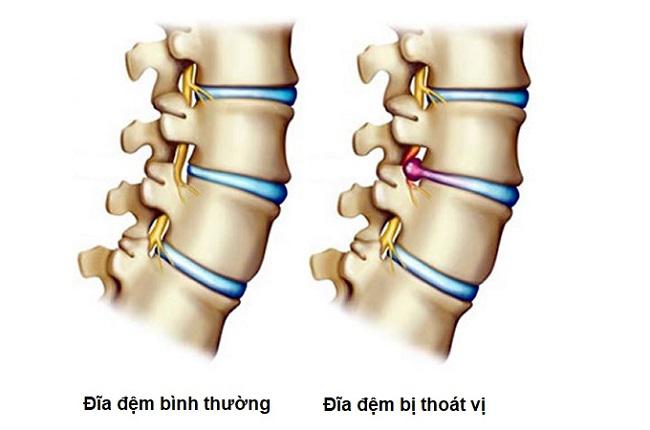 Khám và điều trị thoát vị đĩa đệm tại Bạc Liêu