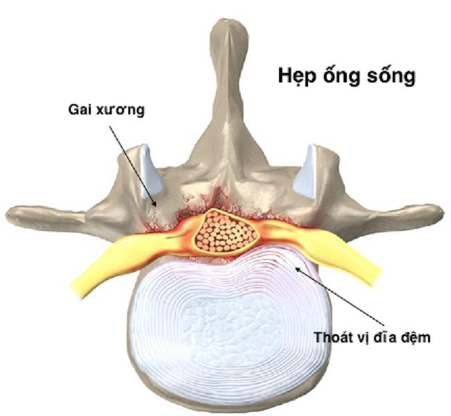 Khám và điều trị bệnh hẹp ống sống tại Bạc Liêu