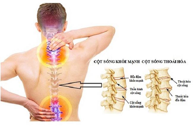 Khám và điều trị thoái hoá cột sống tại Bạc Liêu