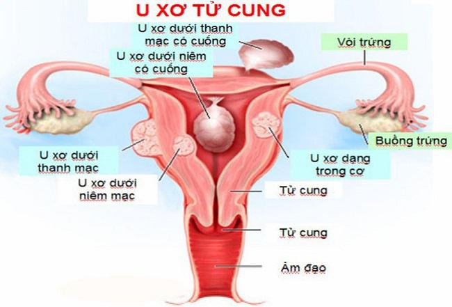 U xơ tử cung có nguy cơ chuyển thành ung thư không?