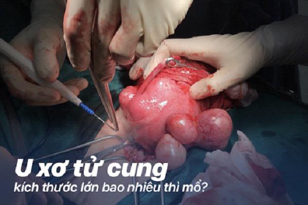 Phẫu thuật u xơ tử cung có nguy hiểm không?