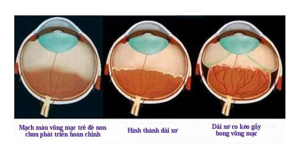 Mức độ nguy hiểm của bệnh võng mạc ở trẻ sinh non