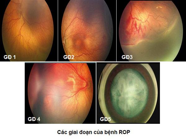 Bệnh võng mạc ở trẻ sinh non diễn biến như thế nào?