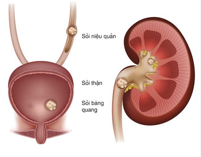 Sỏi tiết niệu và tán sỏi ngoài cơ thể