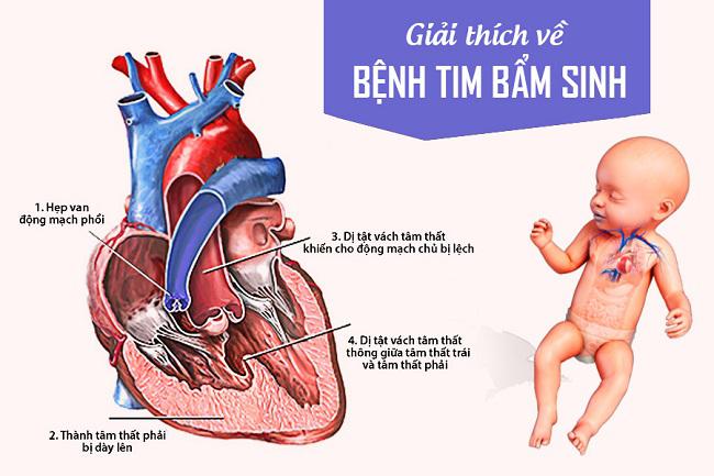 Dị tật tim bẩm sinh và những dấu hiệu cần biết