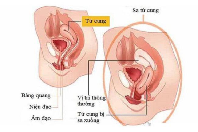 Top 6  bệnh lý thường gặp ở tử cung