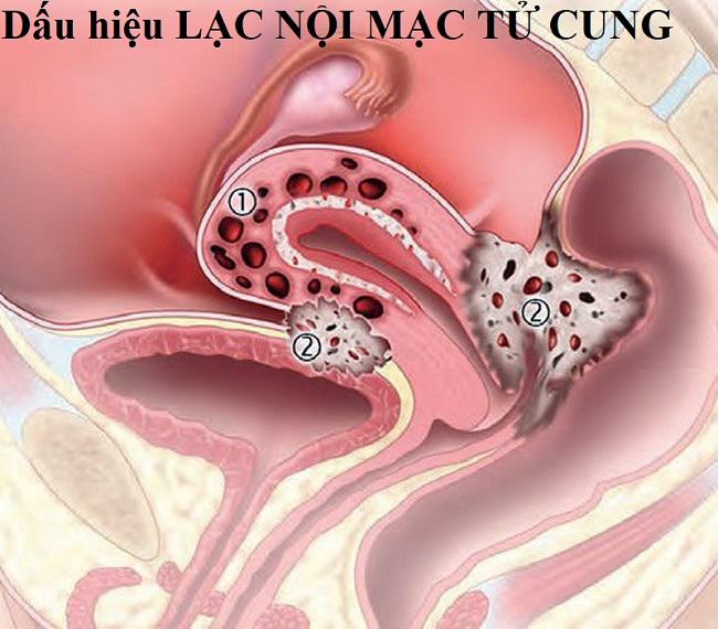 Top 6  bệnh lý thường gặp ở tử cung