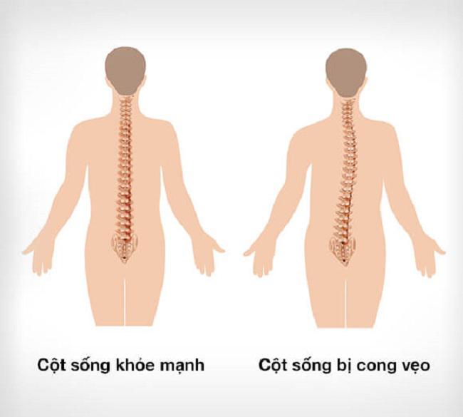 Khám và điều trị cong vẹo cột sống tại Bạc Liêu