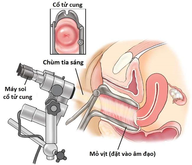 Soi cổ tử cung và những điều có thể bạn chưa biết