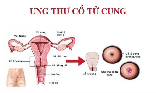 Soi cổ tử cung – Phương pháp phát hiện sớm ung thư cổ tử cung