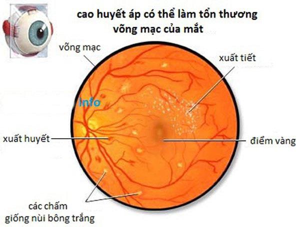 Tìm hiểu về bệnh võng mạc