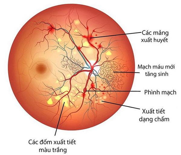 Tìm hiểu về bệnh võng mạc