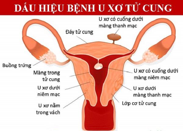 Có thể bạn chưa biết: Biến chứng nghiêm trọng của u xơ tử cung