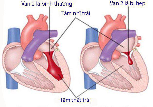 7 bệnh tim mạch thường gặp và các triệu chứng 