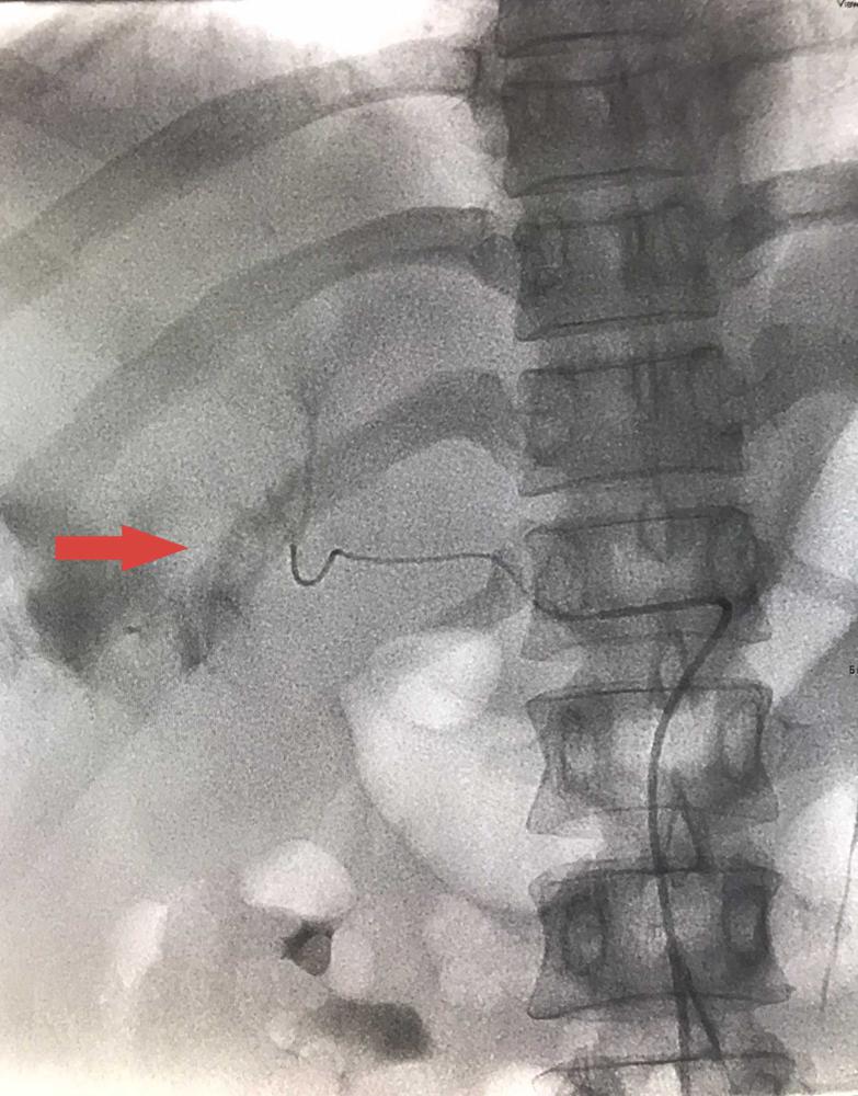 Sau can thiệp DSA, vết thương đã cầm máu, bệnh nhân vượt qua nguy kịch