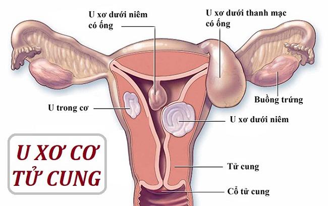 Top 6  bệnh lý thường gặp ở tử cung