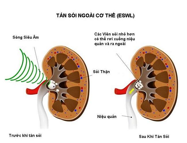 Sỏi tiết niệu và tán sỏi ngoài cơ thể