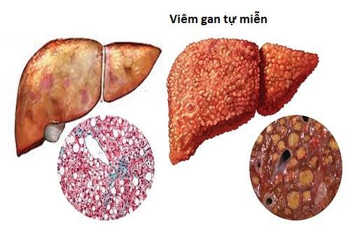 Những điều cần biết về viêm gan tự miễn