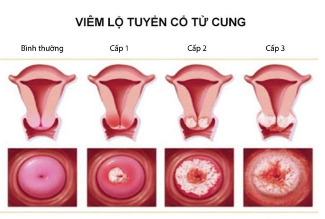 Top 6  bệnh lý thường gặp ở tử cung