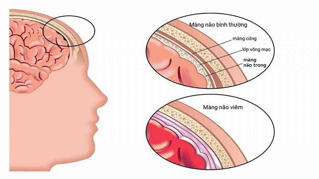 Biến chứng và di chứng của viêm màng não mủ ở trẻ sơ sinh