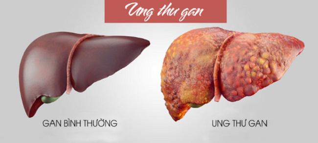 Xơ gan có nguy hiểm không? Nên ngăn ngừa biến chứng xơ gan bằng cách nào?