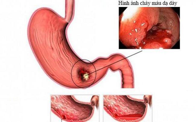 Mức độ nguy hiểm của viêm loét dạ dày tá tràng