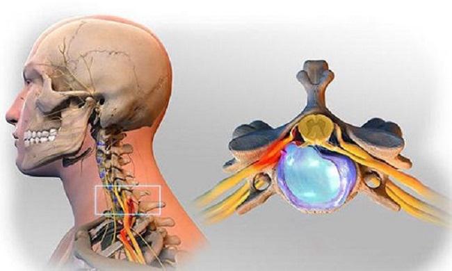 Khám và điều trị bệnh hẹp ống sống tại Bạc Liêu