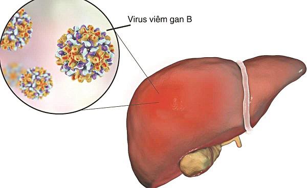 Điểm tên các bệnh thường gặp ở gan