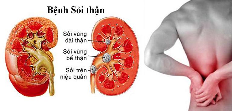  Bệnh sỏi thận