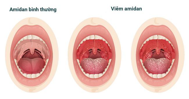 Viêm amidan là gì? Viêm amidan có nguy hiểm không?