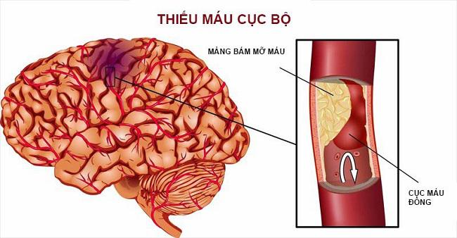 Nguyên nhân hàng đầu gây đột quỵ - Cục máu đông trong não