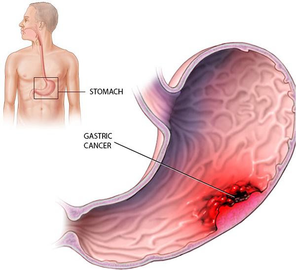 Nguy hiểm khôn lường nếu mắc phải bệnh ung thư dạ dày