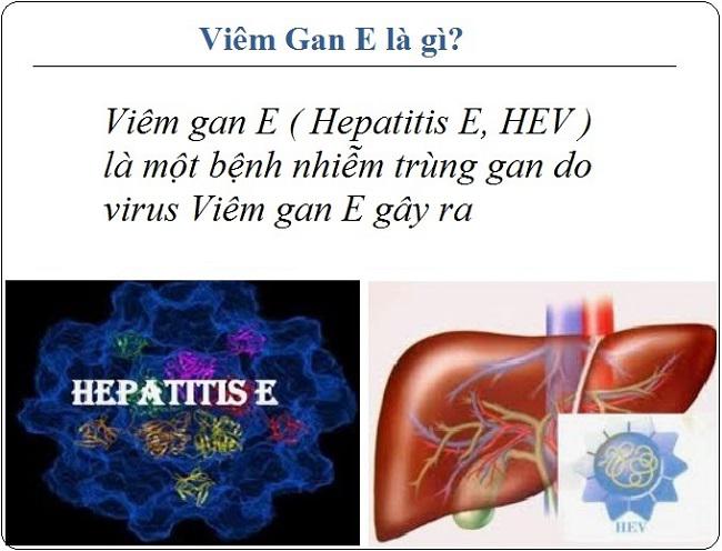 Bệnh viêm gan E là gì? Viêm gan E có nguy hiểm hay không?