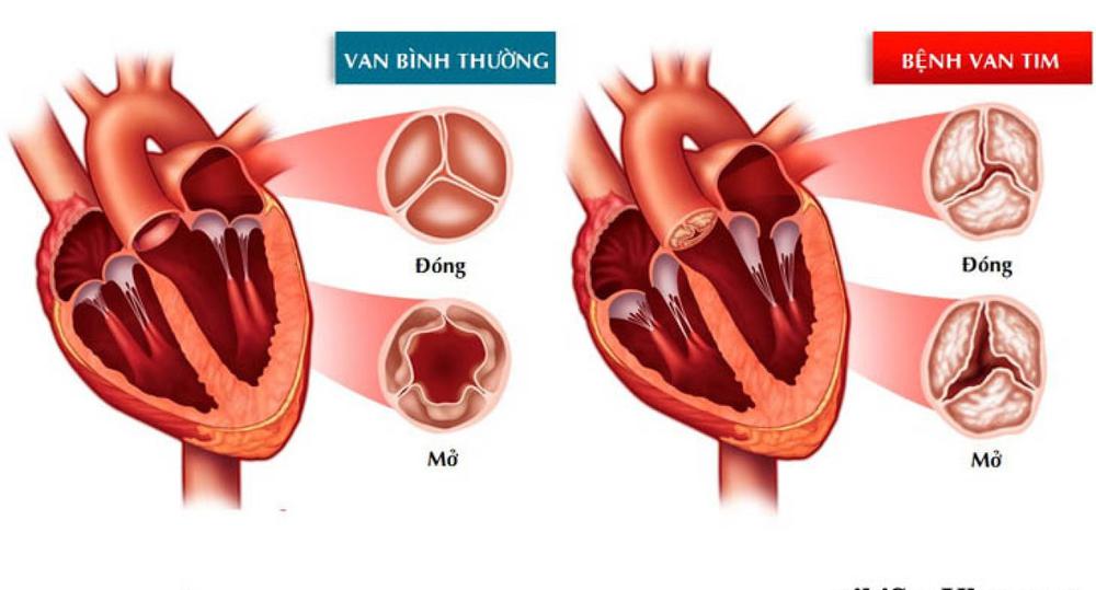 7 bệnh lý tim mạch thường gặp