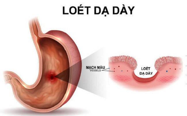 Mức độ nguy hiểm của viêm loét dạ dày tá tràng