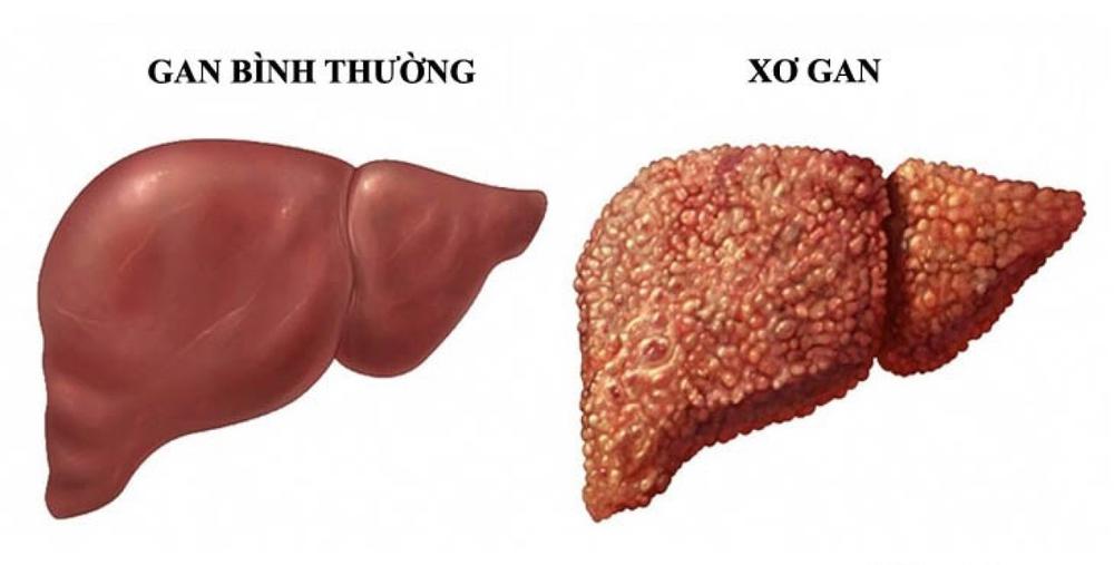 Điểm tên các bệnh thường gặp ở gan