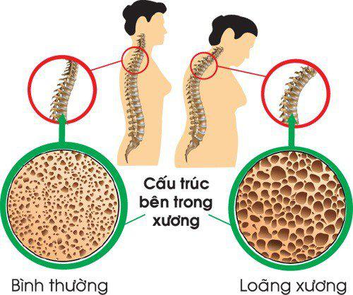 Bệnh loãng xương - Nguyên nhân và cách điều trị