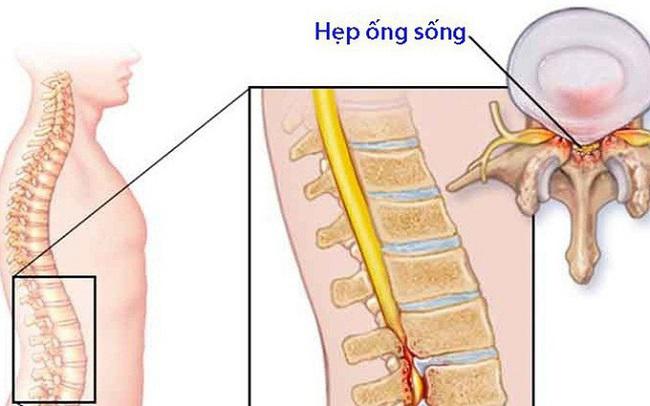 Khám và điều trị bệnh hẹp ống sống tại Bạc Liêu 