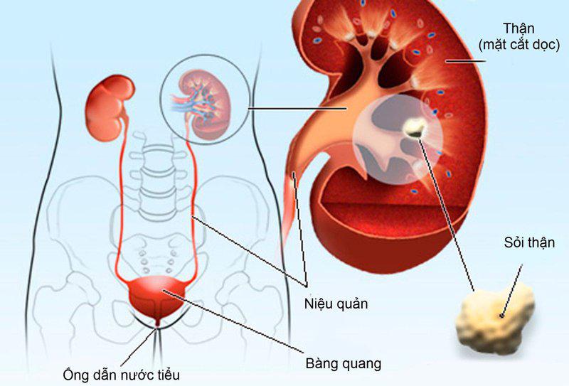 bệnh sỏi thận và những điều cần biết