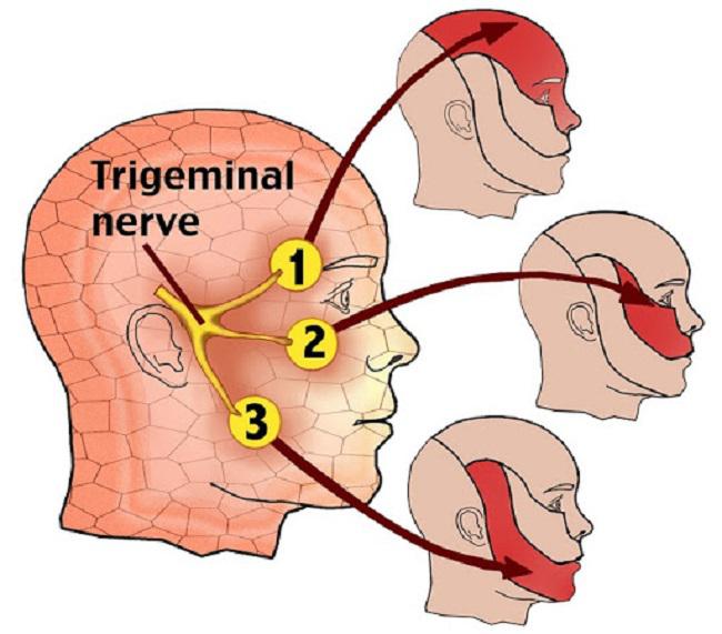 Đau dây thần kinh sinh ba và những biến chứng có thể bạn chưa biết