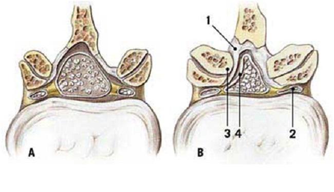 Khám và điều trị bệnh hẹp ống sống tại Bạc Liêu 