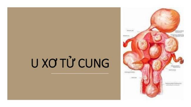 U xơ tử cung có nguy cơ chuyển thành ung thư không?