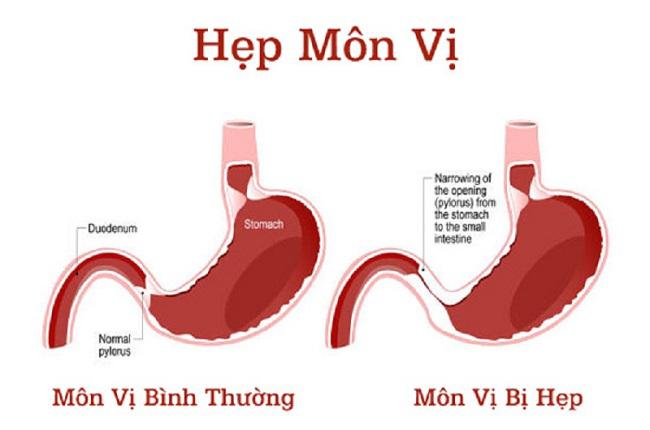 Mức độ nguy hiểm của viêm loét dạ dày tá tràng