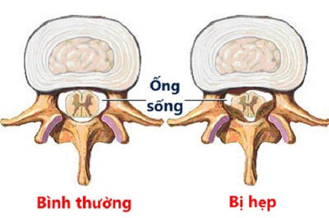 Khám và điều trị bệnh hẹp ống sống tại Bạc Liêu 