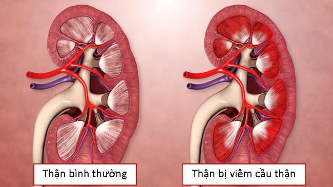 Viêm cầu thận và triệu chứng thường gặp