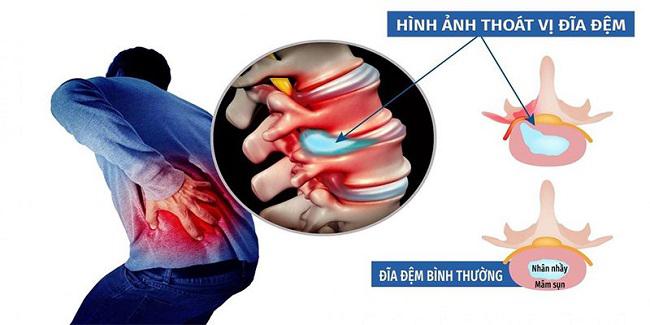 Khám và điều trị thoát vị đĩa đệm tại Bạc Liêu