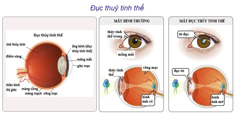 nguyên nhân đục thủy tinh thế