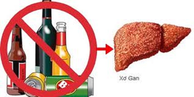 Làm thế nào để phát hiện sớm bệnh xơ gan?