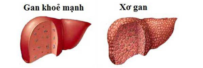 Bệnh xơ gan là gì? Xơ gan có mấy giai đoạn?